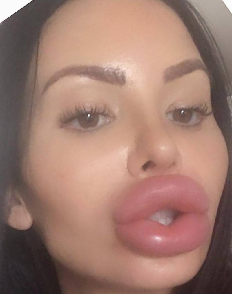 Накаченные силиконом губы